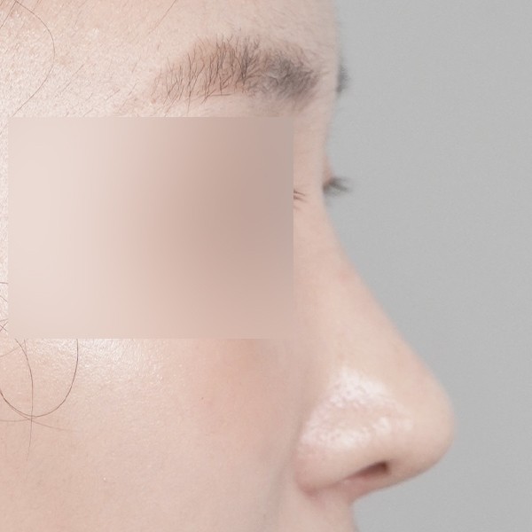 코끝,비중격,귀연골,매부리,복코,휜코,비순각
